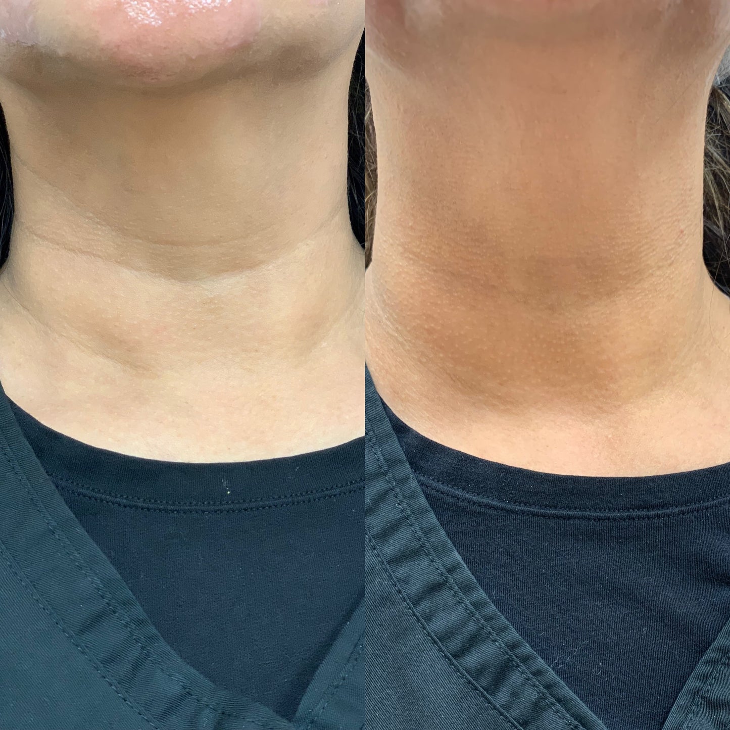Neck Smoothing Patch