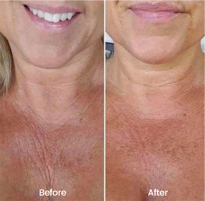 Chest Smoothing Patch